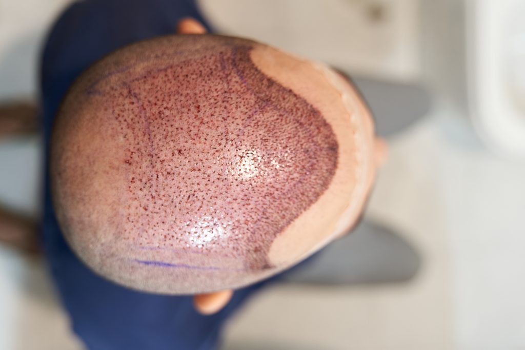 hair transplant turkey cost